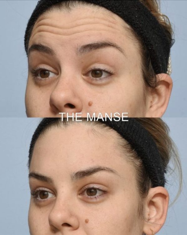 Forehead treatment before and after